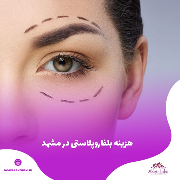 هزینه بلفاروپلاستی در مشهد